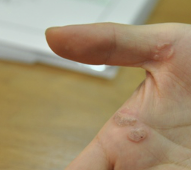 사마귀 제거방법 11