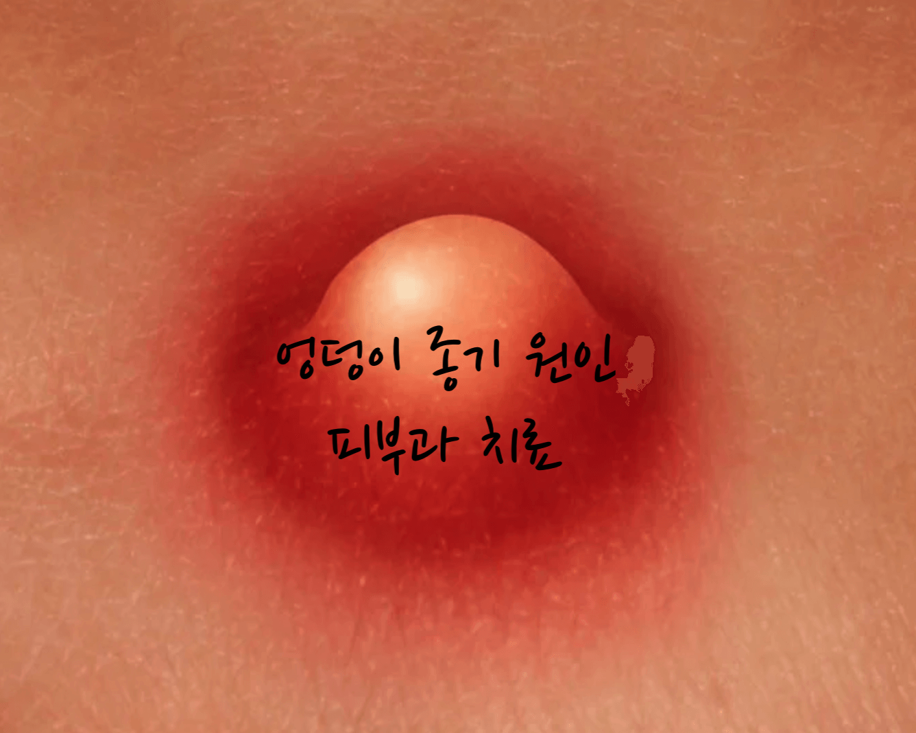 엉덩이 종기 원인