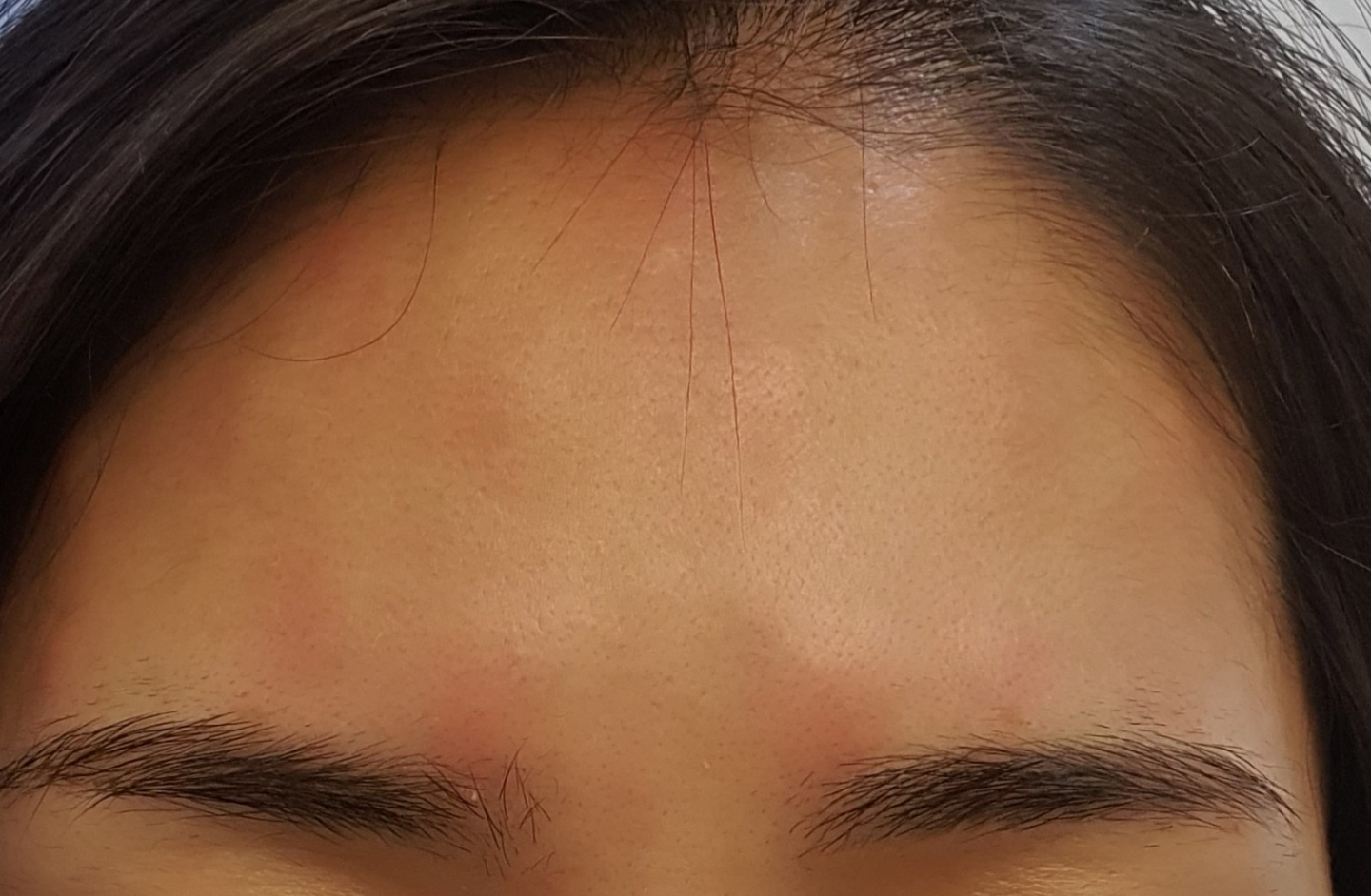 이마보톡스 후기