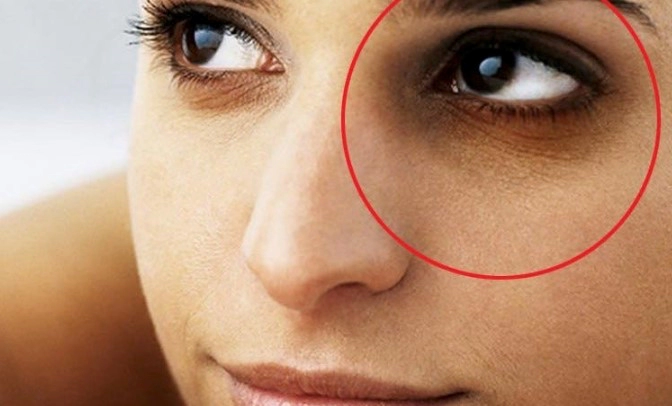 다크서클 자주 묻는 질문들(FAQ)