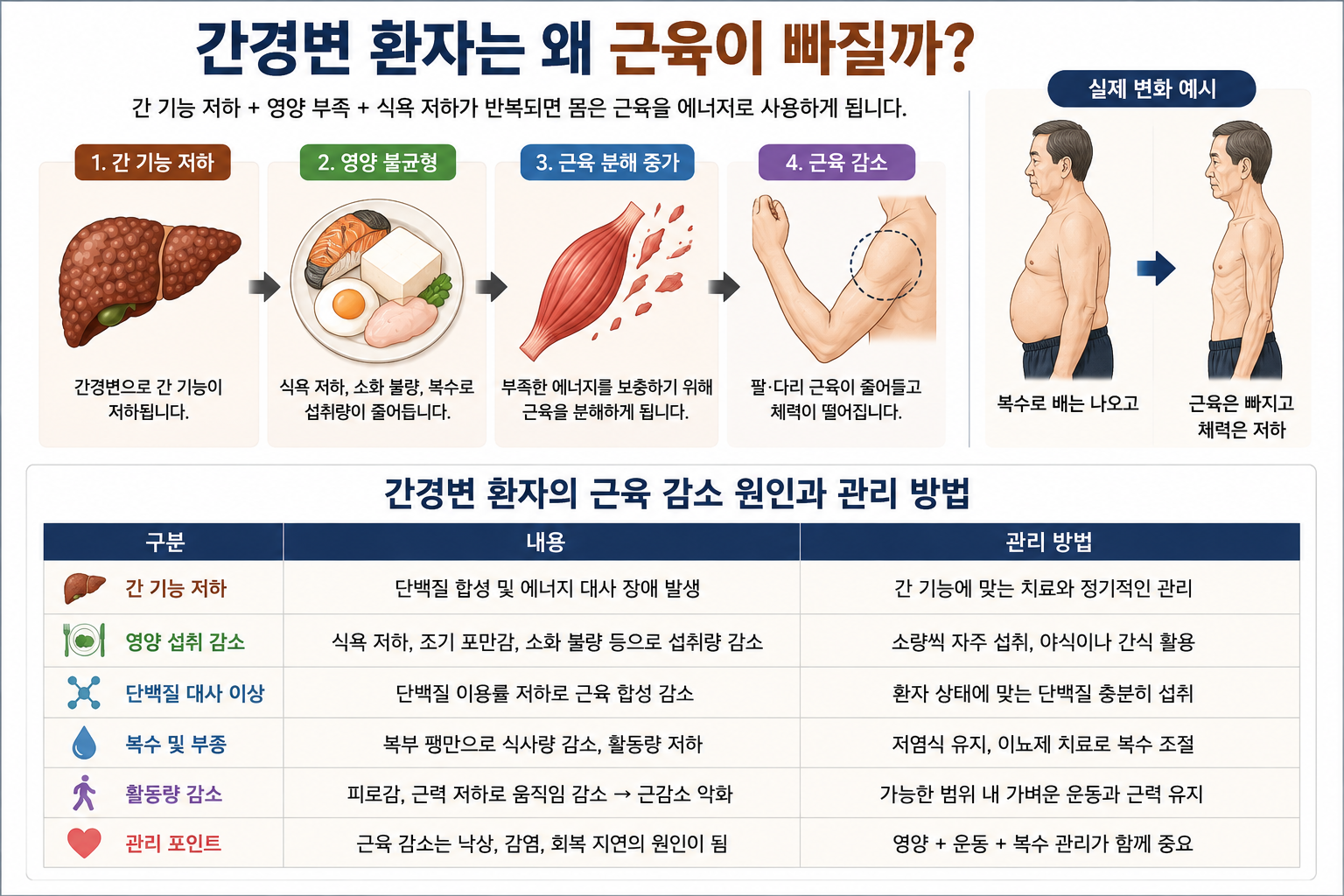 간경변 환자에서 영양 부족과 식욕 저하로 근육 분해가 진행되고 근감소가 발생하는 과정을 설명하는 의료 인포그래픽 이미지