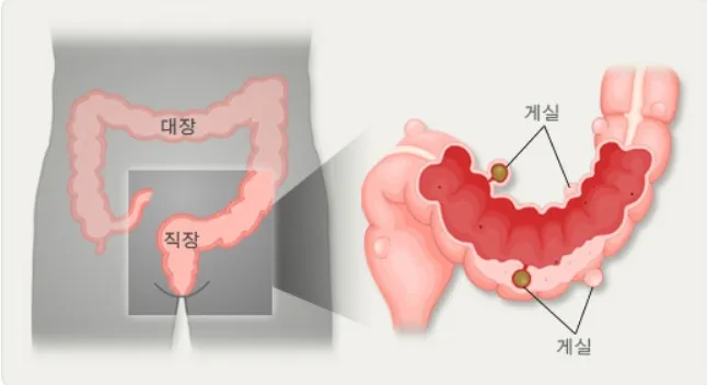 대장게실 대장게실염 대장게실증