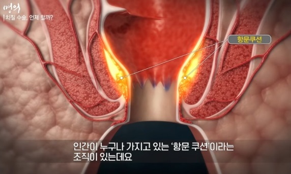 항문쿠션