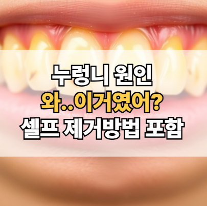 누렁니-원인-제거-셀프-미백