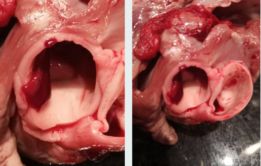 대동맥 박리와 관련된 사진2