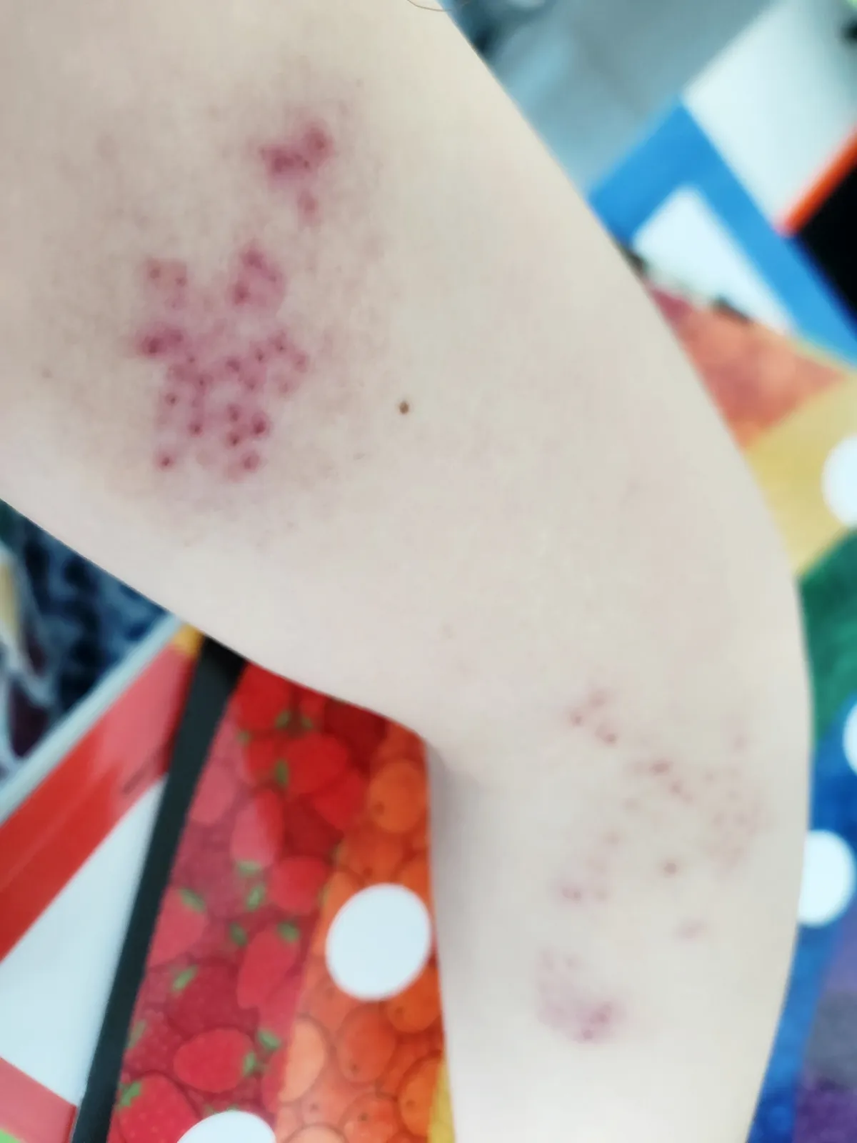 대상포진-팔뚝-수포-점처럼-깔-변함