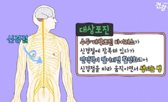 대상포진
