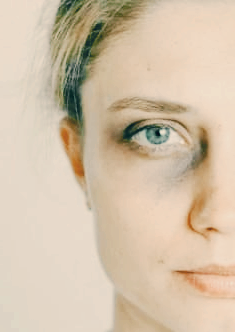 멍이 잘 드는 이유와 오래가는 이유, 병일까?