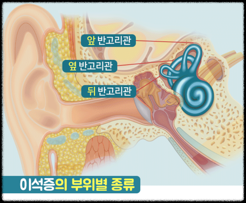 어지럼증 치료 약 어지럼증에 좋은 음식