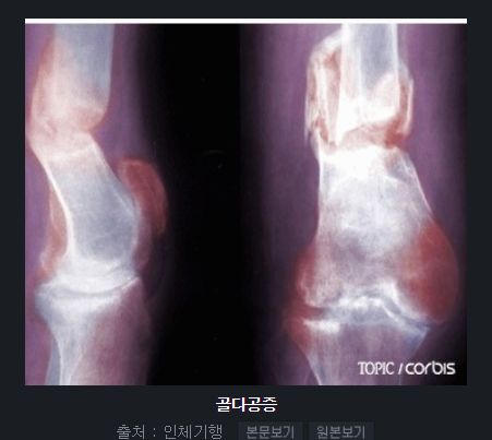 골다공증 주사란? 효과, 부작용, 치료 방법 총정리