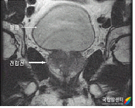 전립선암, PSMA PET/CT, PSA 검사, 전립선암 생존율, 건강보험 급여