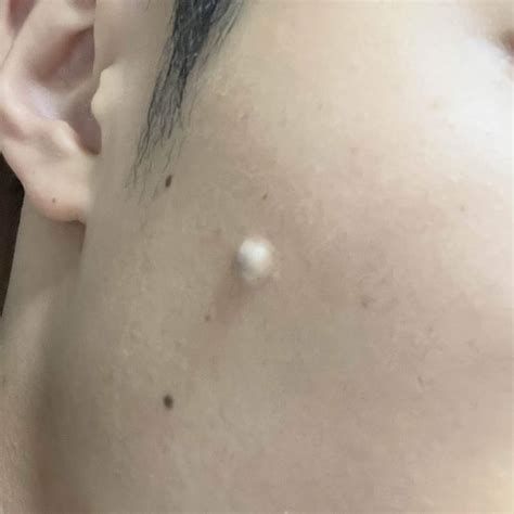 표피낭종 수술