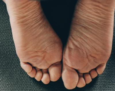 티눈 없애는 방법