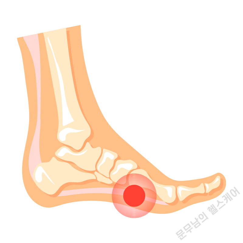 족저근막염 원인