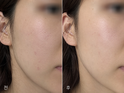 물광주사 시술 전 푸석하고 거친 피부결에서 시술 후 은은한 겉광채와 보습감이 채워져 매끈해진 얼굴 볼 부위 비포 애프터 비교 사진