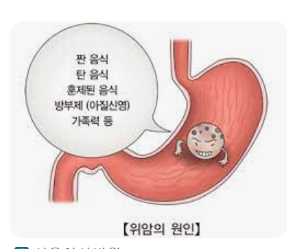 위암 초기 증상