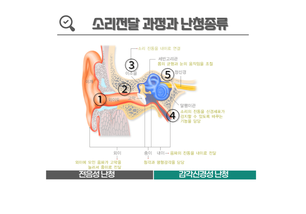 소리 전달 경로에 따른 난청종류
