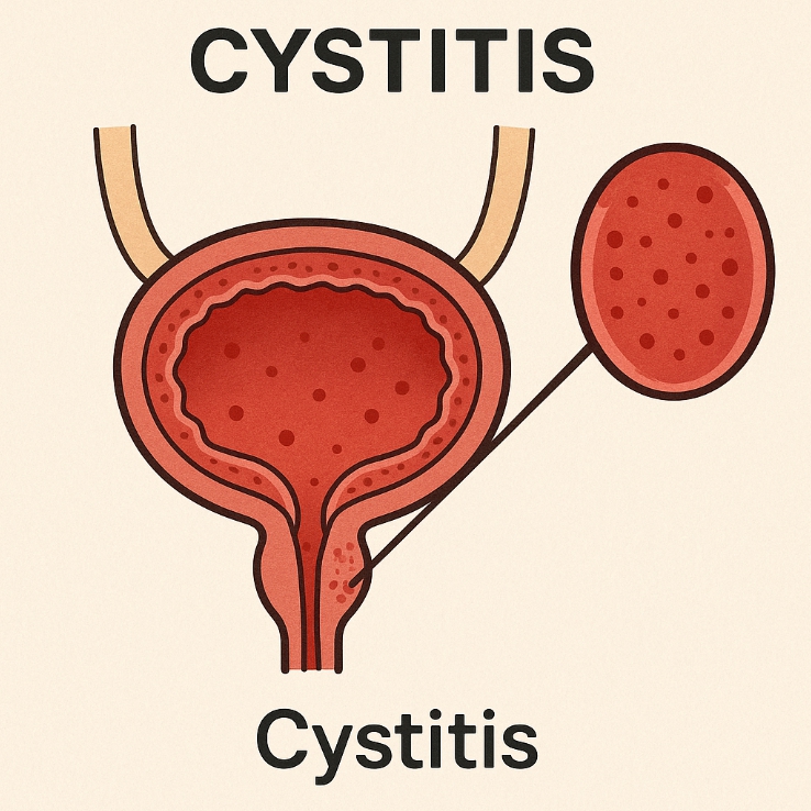 방광염 관련 자료 사진