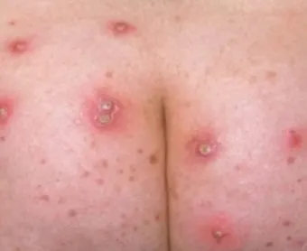 엉덩이 종기가 생기는 이유 왜 생기고 어떻게 관리할까요 완벽 가이드_6