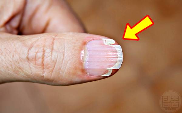 손톱 갈라짐 이유 손톱부러짐