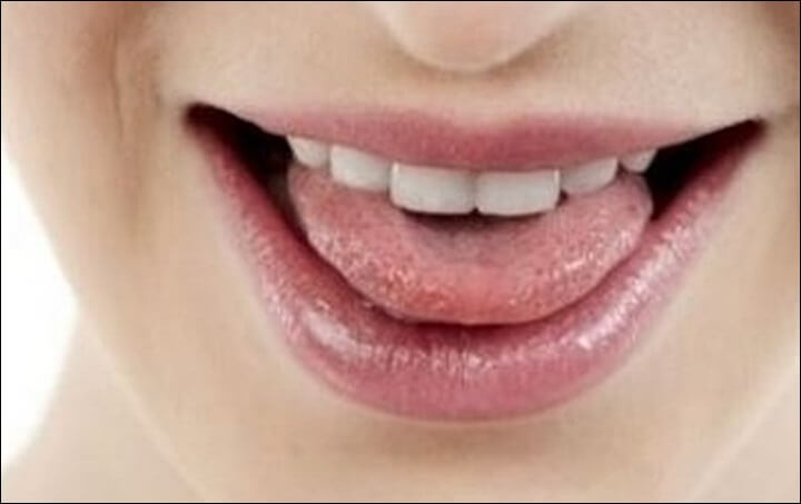 혓바늘이 돋는 이유 면역력