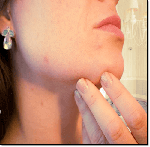 아토피 피부 여성