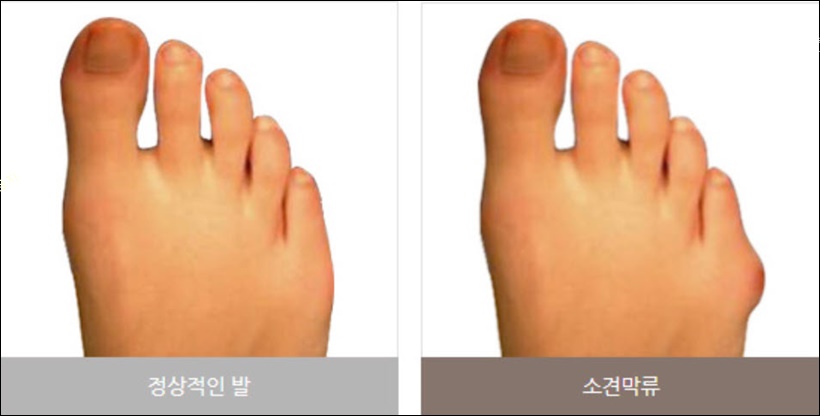 새끼발가락 소건막류 증상