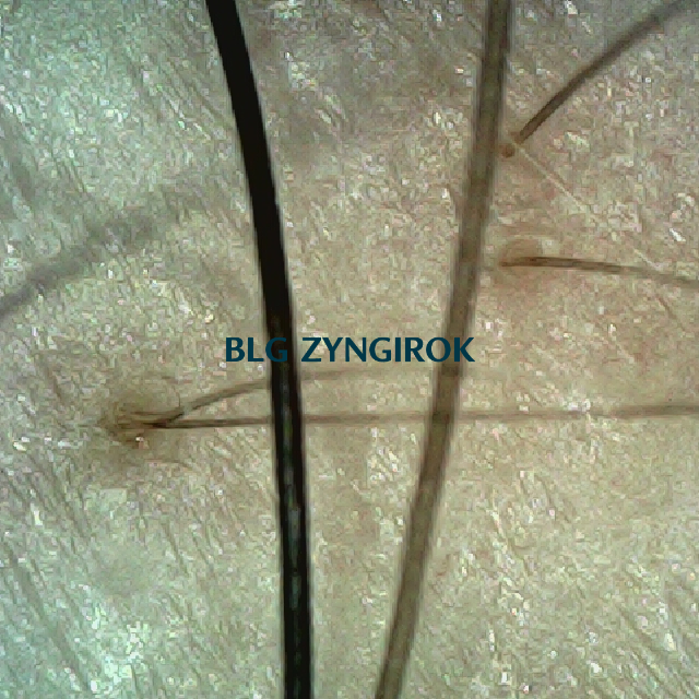 피나모아 복용 14주차 두피 사진 오른쪽 M자 부위 모습이다.