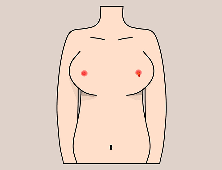 유두에서-피가-나는-여성