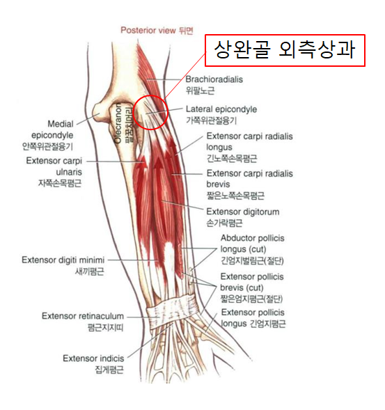 테니스 엘보
