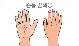 손톱 꿈해몽