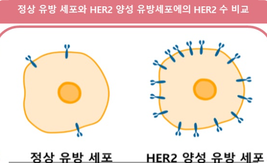 HER2 전이성 유방암 표적 치료제 발전과 효과 관련 이미지