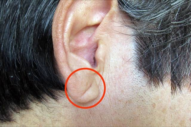 얼굴주름 골다공증 팔자주름 귓볼주름 심장마비