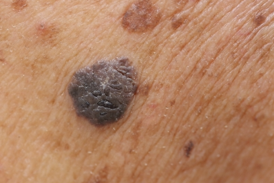 검버섯 없내는 방법