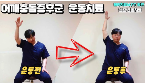 어깨 충돌 증후군 운동치료 전 후 비교