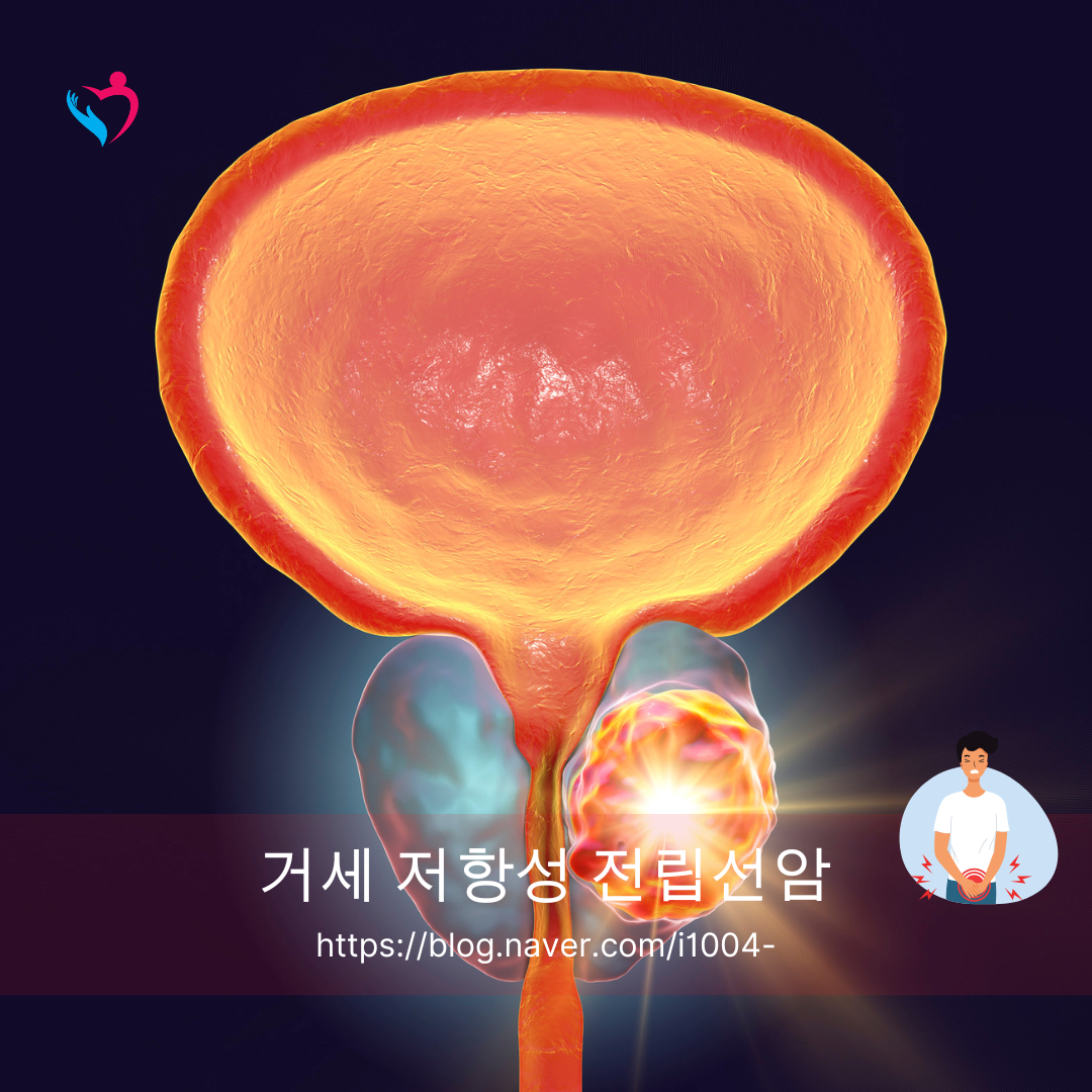 최신 의료 루테슘(Lu-177) PSMA 거세 저항성 전립선암 치료에 대해