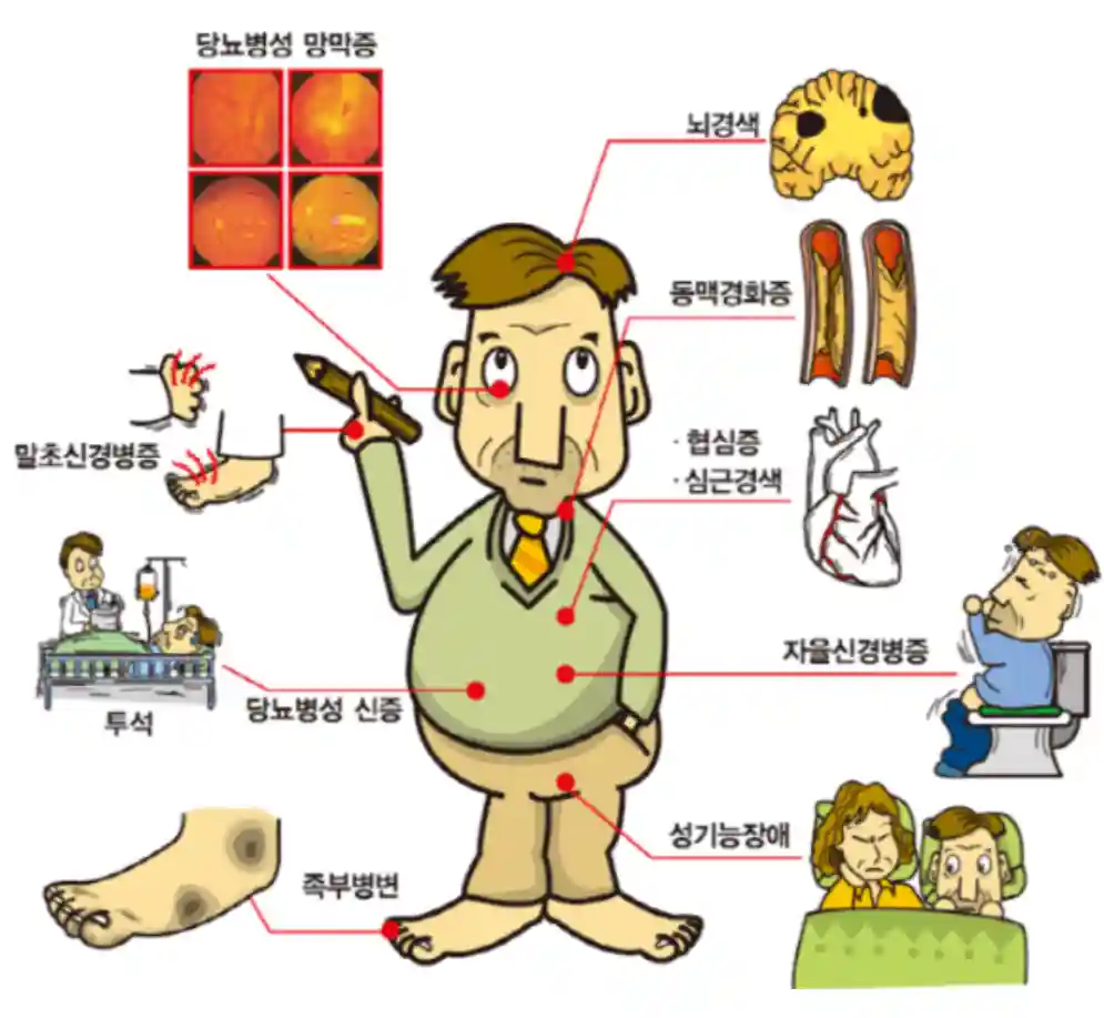 당뇨 합병증