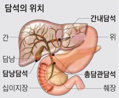 담석증 증상
