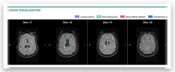 지속적 모니터링에 특화된 종단 분석 -장애정도 분석