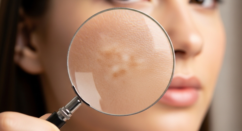 멜라논크림 효과 