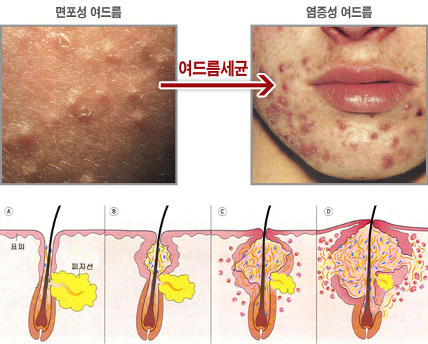 여드름 종류