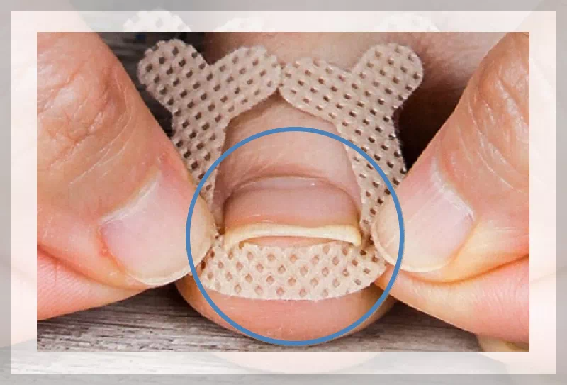 내성발톱 육아종의 치료 방법