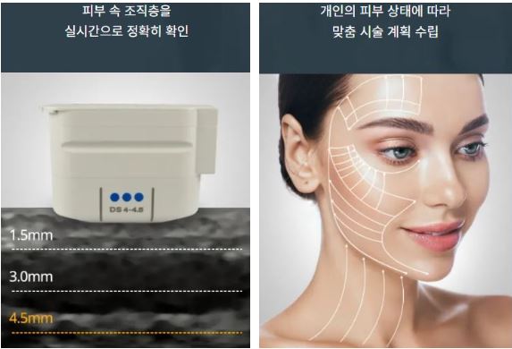 울쎄라효과