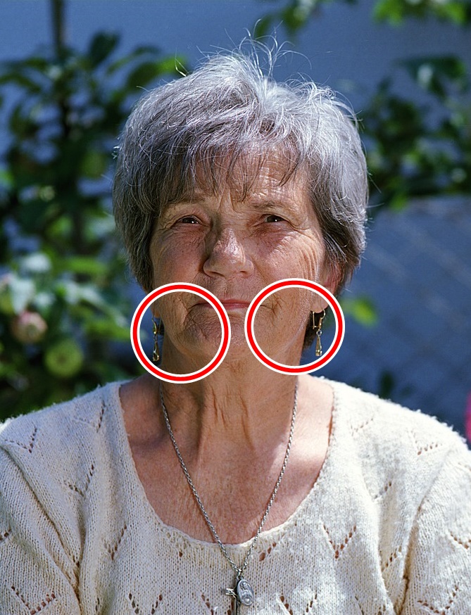 얼굴불독살_제거방법