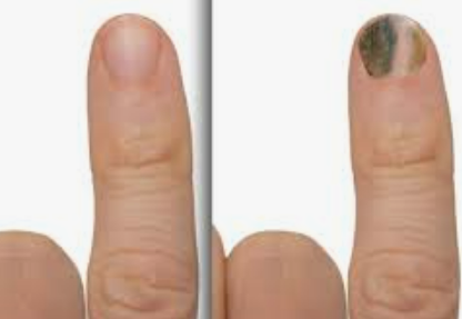 건강 상태 변화 : 몸의 변화를 알려주는 손톱