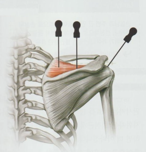 회전근개증후군의 진단