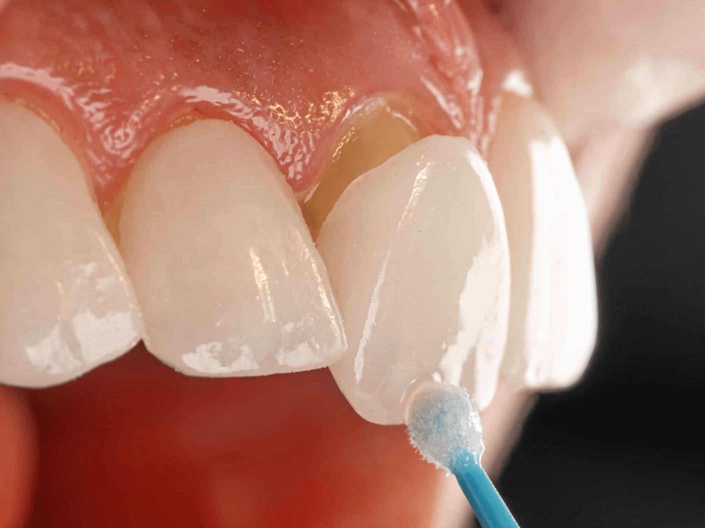 앞니 깨짐 소요시간