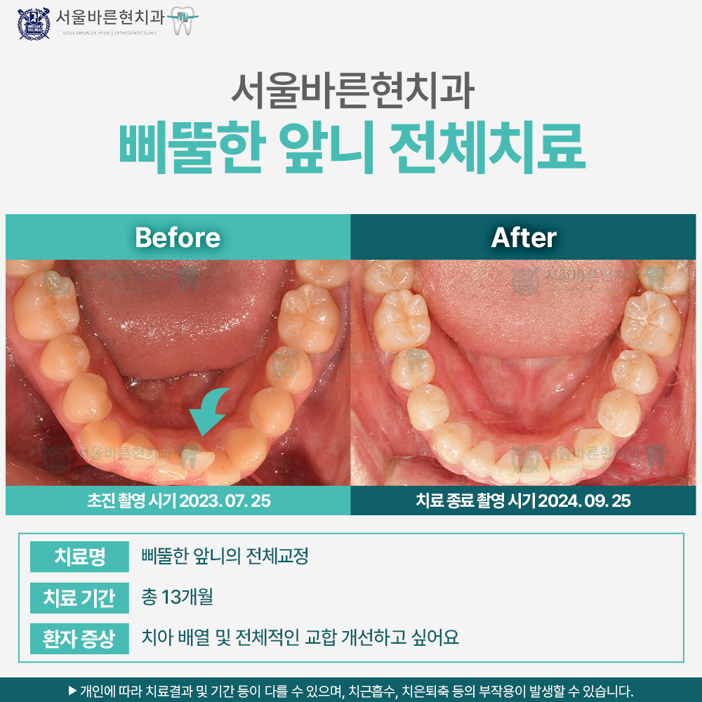 부산치아교정