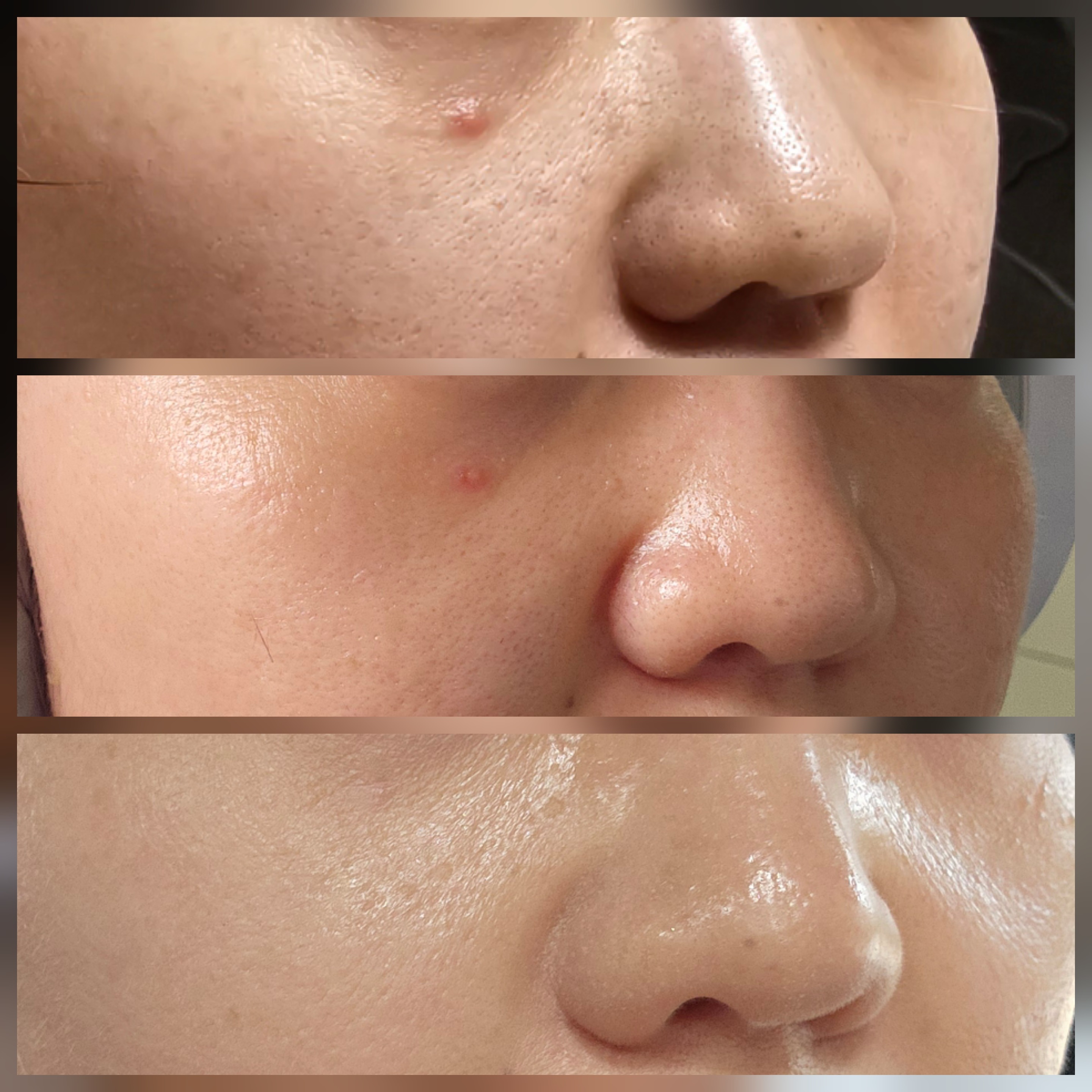 세포랩 사용 후 피부 변화를 1일 3일 1개월 간격으로 촬영하여 비교해보았다. 한 눈에 보기에도 눈에 띄게 좋아진 것을 볼 수 있다