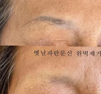 눈썹 문신 제거 방법 꿀팁_5
